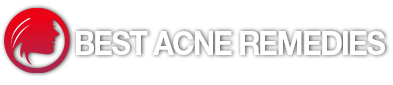 Best Acne Remedies